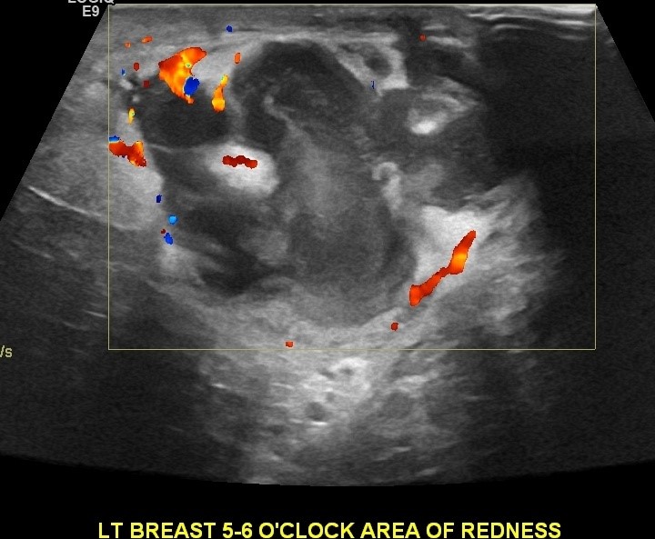 Ultrasound-showing-a-breast-abscess-in-a-breast-feeding-woman