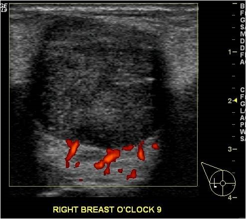 Ultrasound-shows-a-non-cancerous-tumor