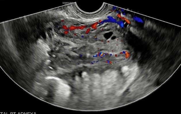 Ultrasound-with-Doppler-shows