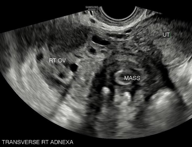 Ultrasound-with-Doppler-shows