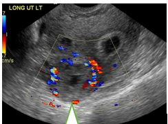 ectopic-pregnancy