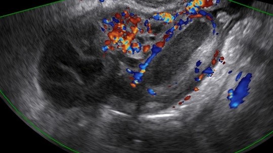 pelvic ultrasound performed for a patient with fever 