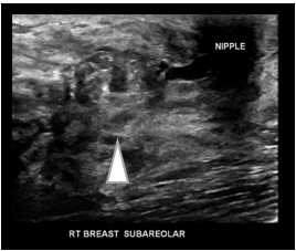 rt-breast-subareolar