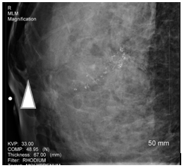 rt-breast-subareolar