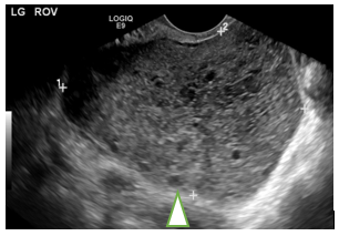 swollen-ovary-without-blood